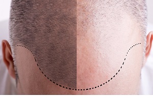 کاشت مو و پاسخ به مهم ترین سوالات مربوط به کاشت
