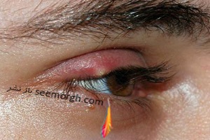 گل مژه چیست و چطور درمان می شود و چه تفاوتی با شالازیون دارد؟