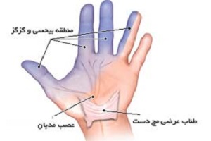 علت ایجاد گزگز دست و روش های درمان آن 