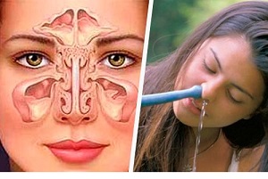 چگونگی شستشوی سینوس ها با آب نمک و جوش شیرین 