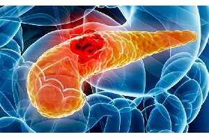پانکراتیت یا التهاب پانکراس چیست؟ از علائم تا درمان 