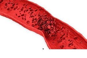 از ایجاد لخته های خونی پیشگیری کنید