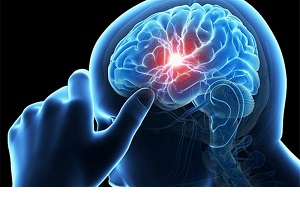 کرونا عامل سکته مغزی