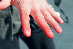 انگشت کوویدی یکی از علائم کرونا