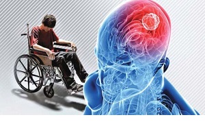 علت تشنج در برخی بیماران مبتلا به ام اس