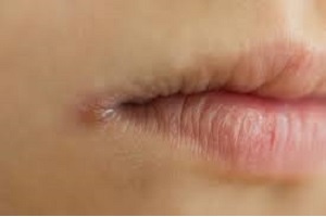 چرا گوشه لب ها ترک می خورد