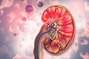 آیا مصرف کلسیم باعث بروز سنگ کلیه می شود؟