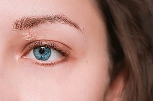 پسوریازیس چشم چیست و چگونه درمان می شود ؟