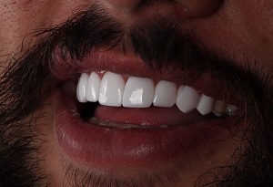 کامپوزیت و لمینت دندان در کلینیک عرشیان Arshianclinic