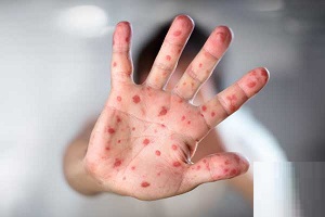 پاسخ به 14 سوال مهم درباره آبله میمونی