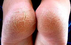 با ترک های کف پا چه کنیم؟