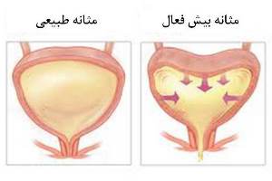 از کجا بفهمیم مثانه بیش فعال داریم؟