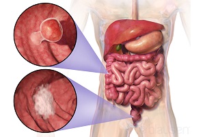 پیشگیری از سرطان روده بزرگ با رعایت این 5 نکته