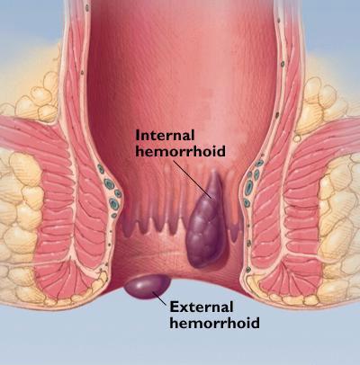 internal-external-hemorrhoids.jpg