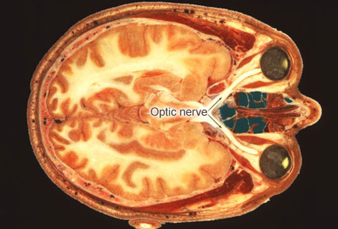 ms-symptoms-vision-problems.jpg