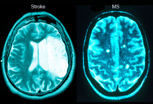 stroke-vs-ms.jpg