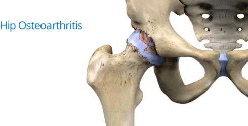 آرتروز مفصل ران Hip osteoarthritis معمولا زودتر رخ می دهد آرتروز مفصل ران Hip osteoarthritis معمولا زودتر رخ می دهد
