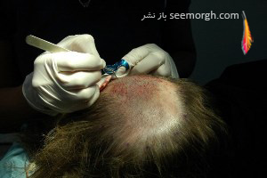 آنچه باید قبل از انجام پیوند موی طبیعی بدانید