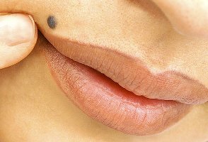 خال هایی که نباید لیزر کرد